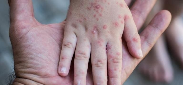 تفشي جدري القرود: منظمة الصحة العالمية تعلن حالة طوارئ ثانية خلال عامين