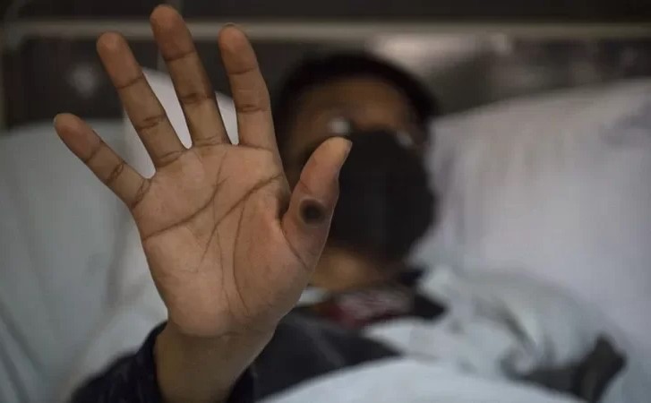 زيادة حالات جدري القردة في أفريقيا: أزمة صحية متنامية