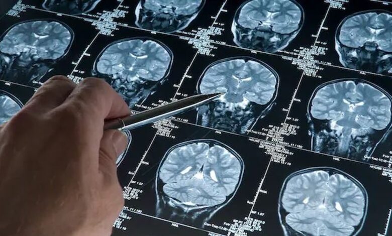 دراسة جديدة: مرضى ألزهايمر أقل عرضة للإصابة بسرطان القولون