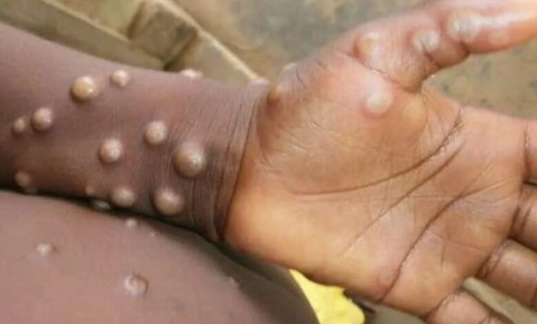 منظمة الصحة العالمية تعقد اجتماعًا طارئًا لمواجهة تفشي جدري القردة